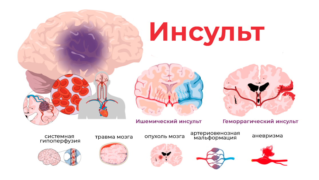 Инсульт головного мозга
